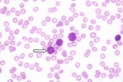 Figure  1:  Peripheral  blood  film  of  the  patient  showed  presence  of  numerous  blast  cells  with  high nuclear:cytoplasmic ratio and inconspicuous nucleoli (arrow). (Wright stain, x 200)